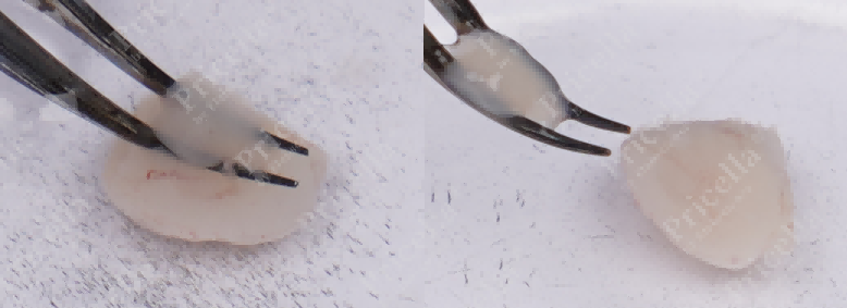 Retain the cerebral cortex